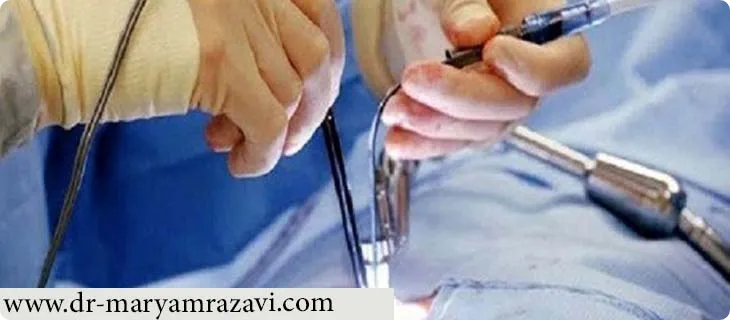 عمل لاپاراسکوپی