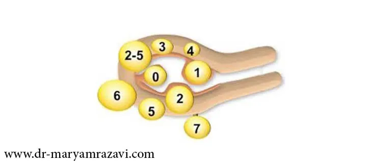 جراحی میومکتومی