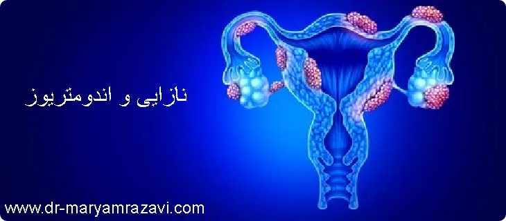 اندومتریوز باعث نازایی می شود