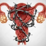 تاثیر اندومتریوز بر نازایی