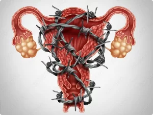 تاثیر اندومتریوز بر نازایی