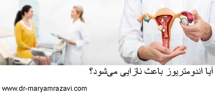 نازایی برای اندومتریوز