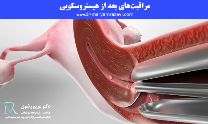 مراقبت های بعد از هیستروسکوپی