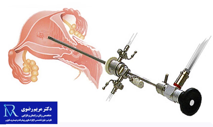 مهم ترین عوارض هیستروسکوپی