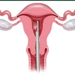 پیشگیری از عوارض هیستروسکوپی