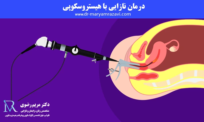 درمان نازایی با هیستروسکوپی