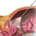 پیشگیری از عوارض لاپاراسکوپی رحم