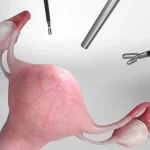 دلایل انجام لاپاراسکوپی هیسترکتومی