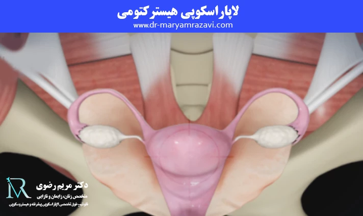 لاپاراسکوپی هیسترکتومی