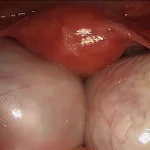 لاپارسکوپی کیست در زاهدان