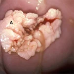 مراقبت های بعد از کولپوسکوپی زگیل تناسلی