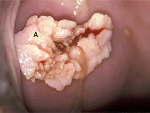 مراقبت های بعد از کولپوسکوپی زگیل تناسلی