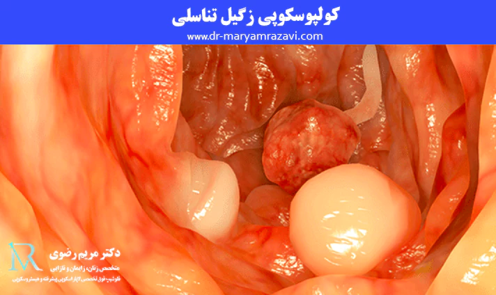 کولپوسکوپی زگیل تناسلی