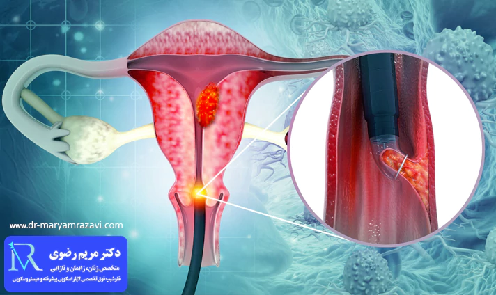 انواع پایپل بیوپسی