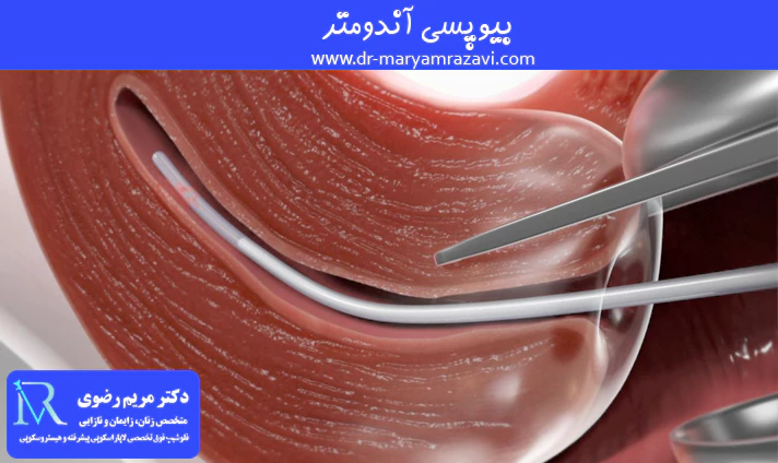 بیوپسی آندومتر