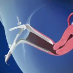 قیمت کولپوسکوپی رحم