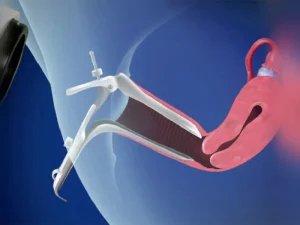 قیمت کولپوسکوپی رحم