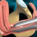 نحوه انجام بیوپسی اندومتر