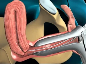 نحوه انجام بیوپسی اندومتر