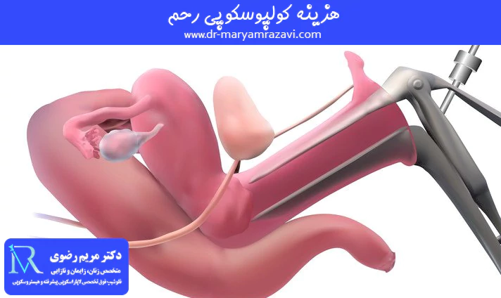 هزینه کولپوسکوپی رحم