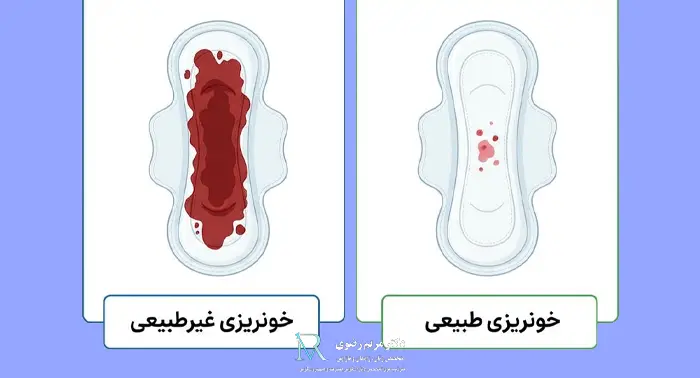 خونریزی بعد لاپاراسکوپی رحم