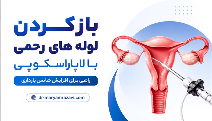 باز کردن لوله های رحمی با لاپاراسکوپی