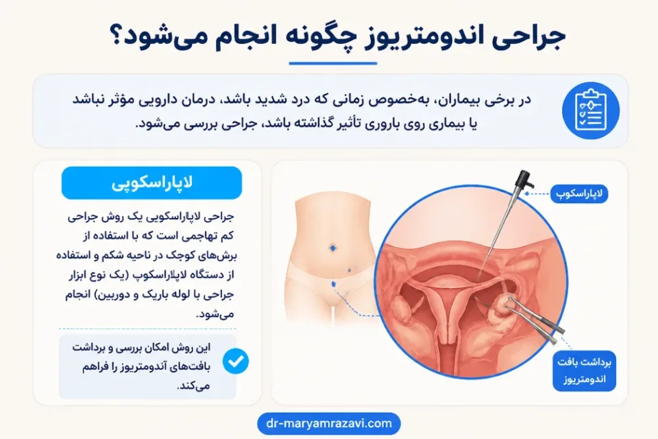 نمای توضیحی درباره جراحی اندومتریوز چگونه انجام میشود
