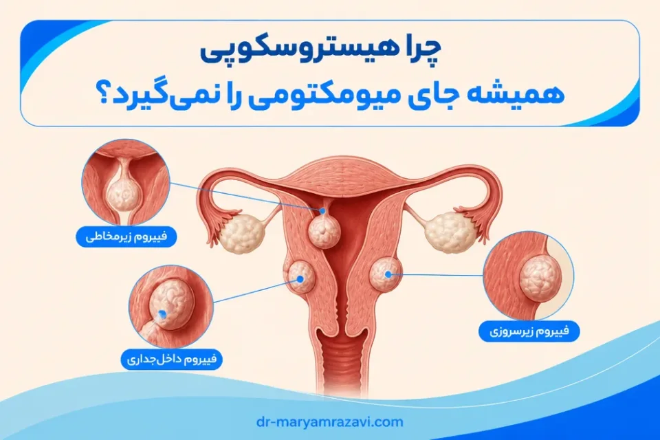 نمای توضیحی درباره چرا هیستروسکوپی همیشه جای میومکتومی را نمیگیرد